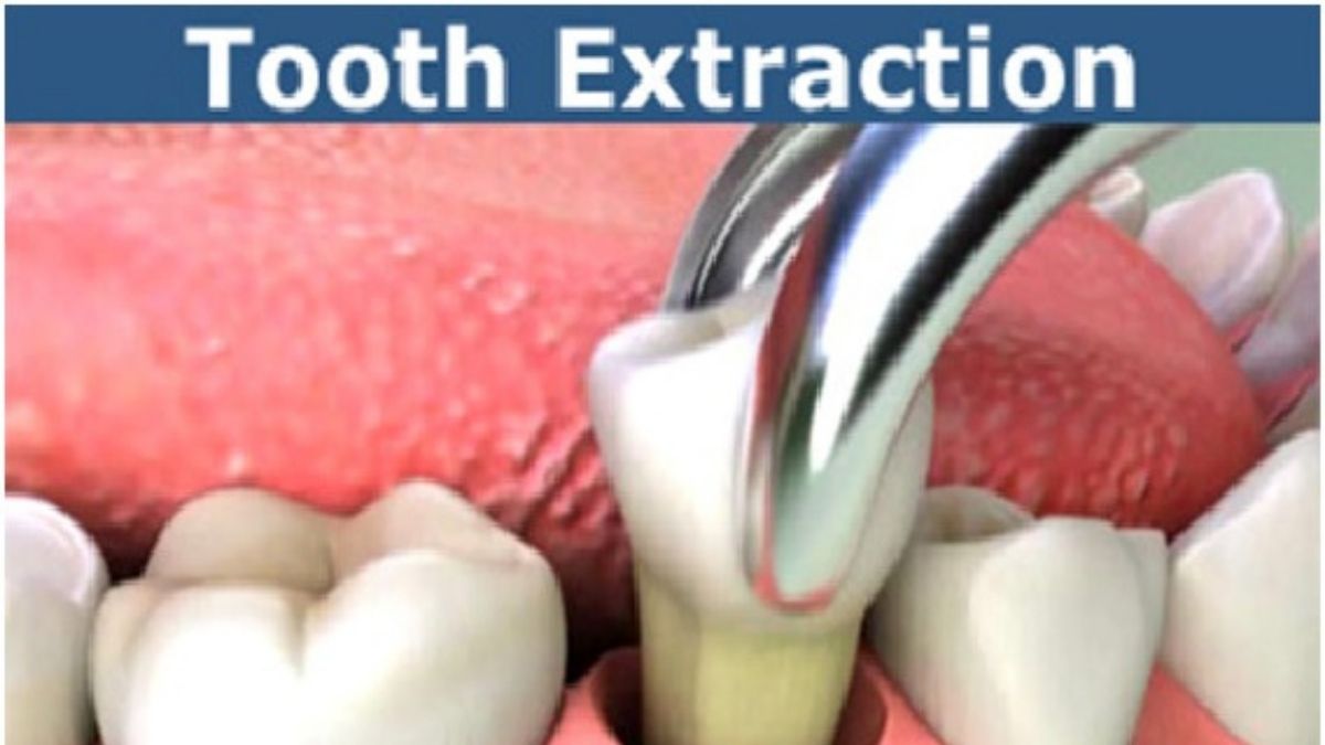 do's and don'ts after tooth extraction, best dentist in udaipur