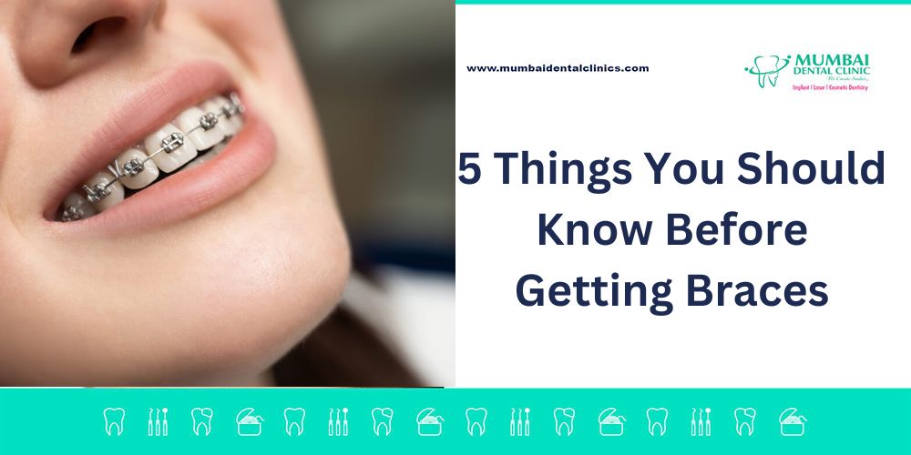 5 Things You Should Know Before Getting Braces