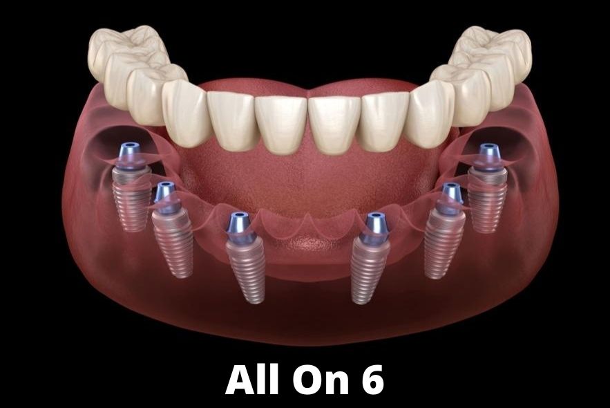 dental implants in Udaipur