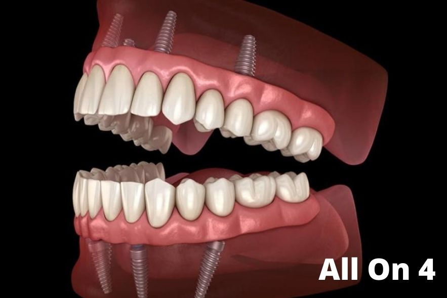 dental implants in Udaipur