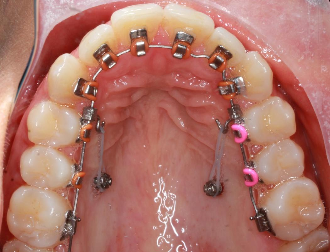 Braces in udaipur