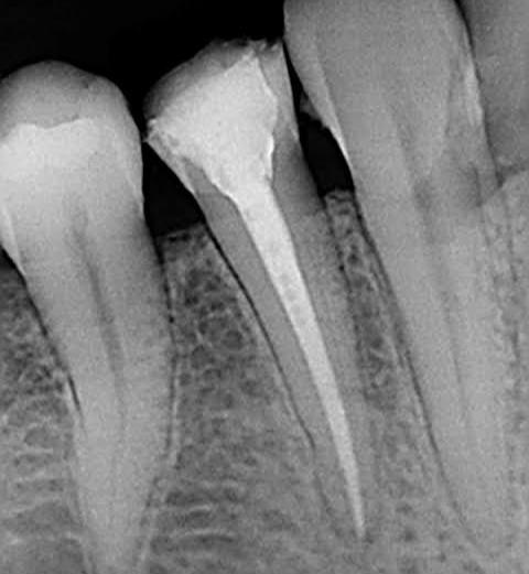 Root canal dentist in udaipur