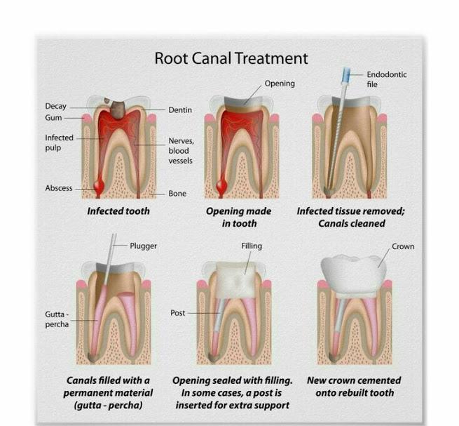 Root Canal Treatment in Udaipur