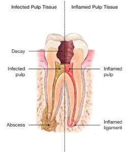 Root canal doctors in udaipur