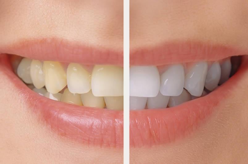 Teeth whitening in Udaipur