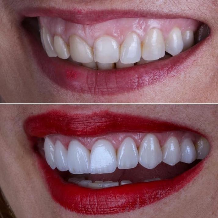 Teeth whitening in Udaipur