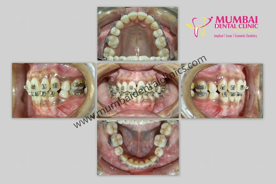 Smile designing in udaipur