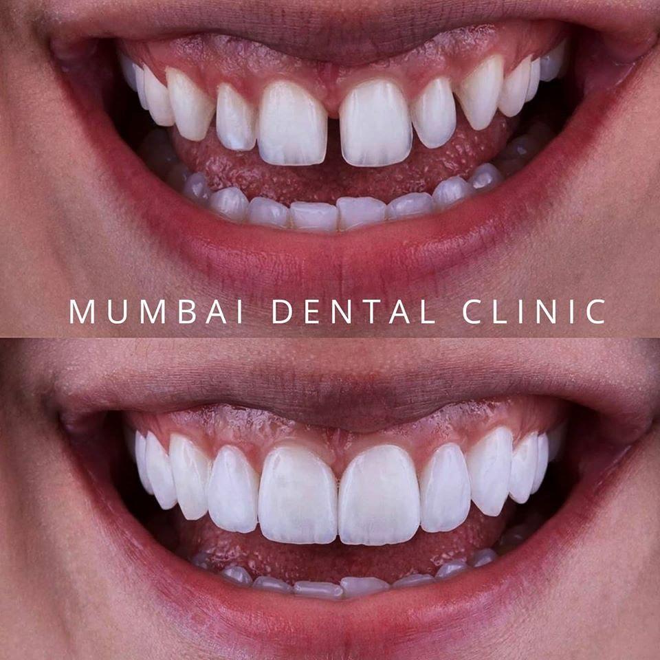 Smile designing in udaipur