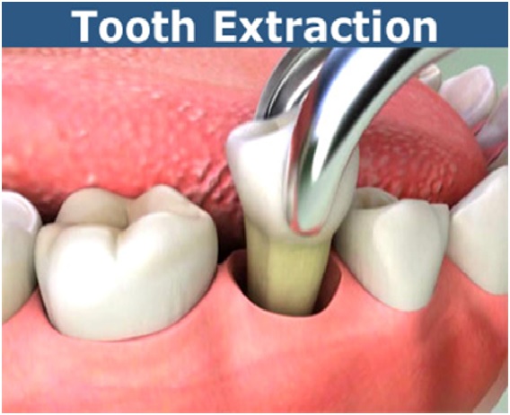 tooth extraction, best dentist in udaipur, best dentist in mumbai, dentist in udaipur