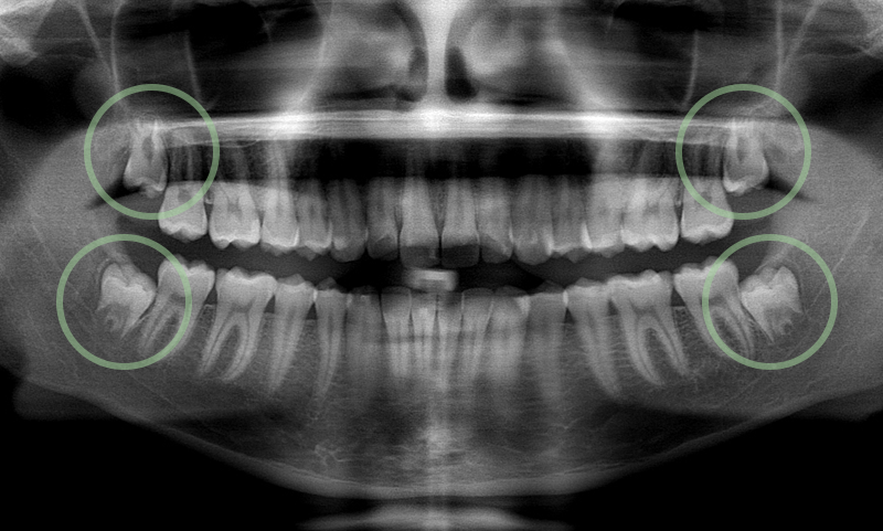 WISDOM TOOTH REMOVAL