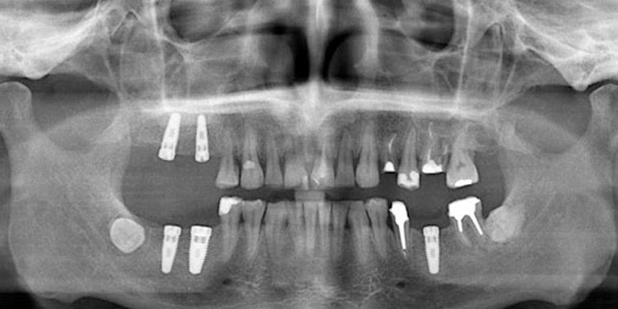 OPG Panoramic Dental X-Ray